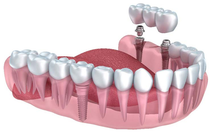 dental implants 