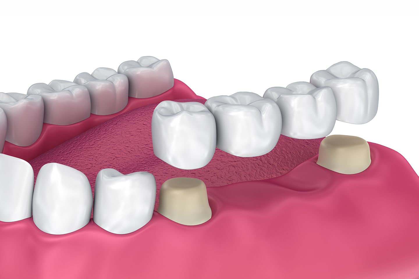 Dental Bridge Benefits - Harrisburg, PA